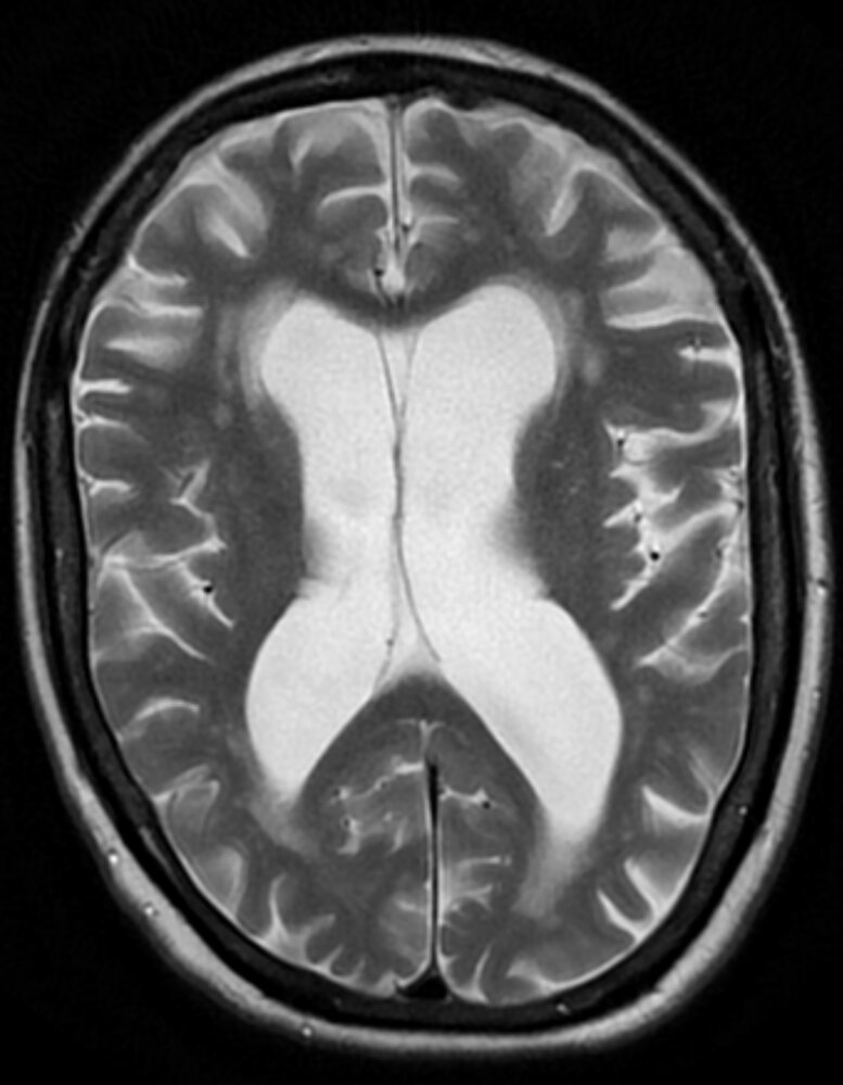 Hydrocephalus ex vacuo