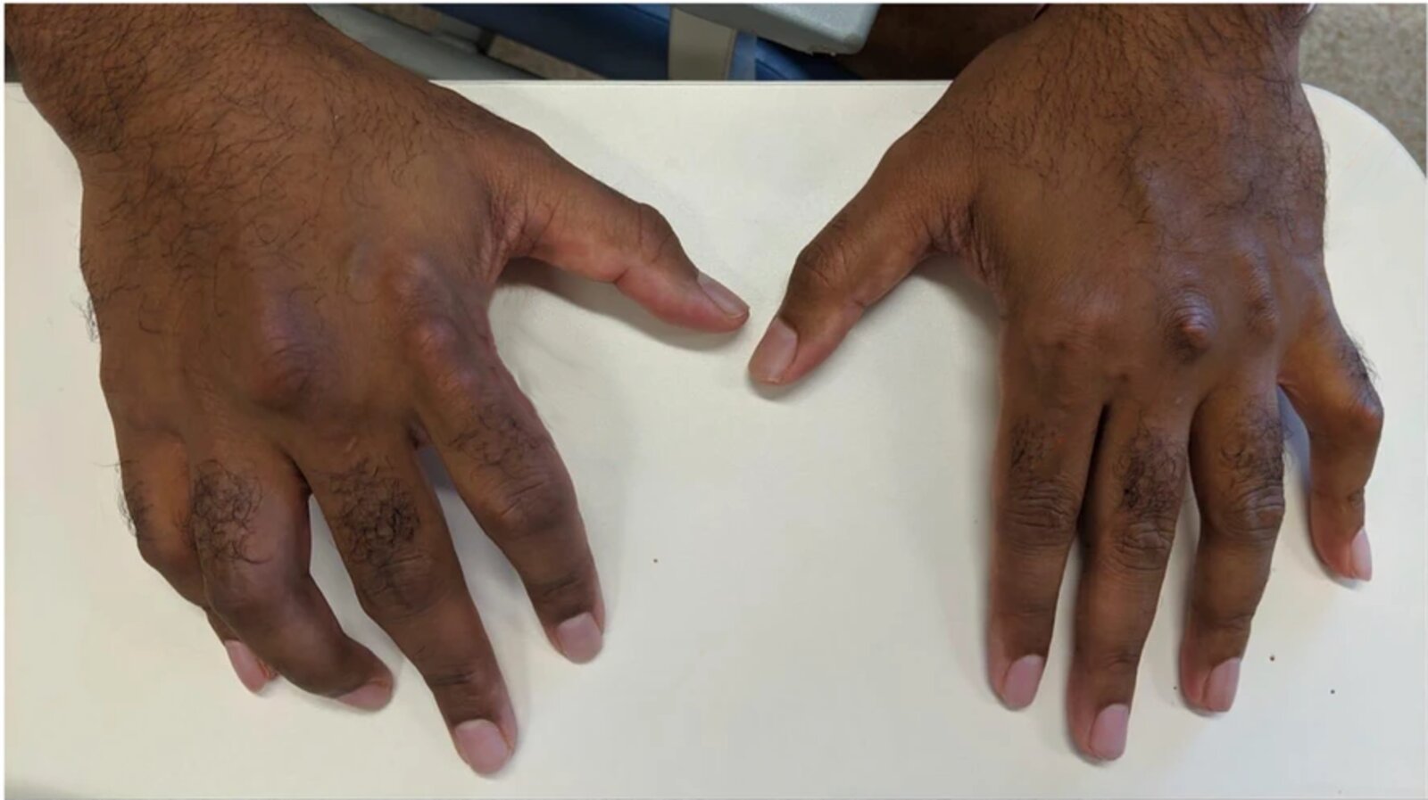 Gouty tophi of the hands