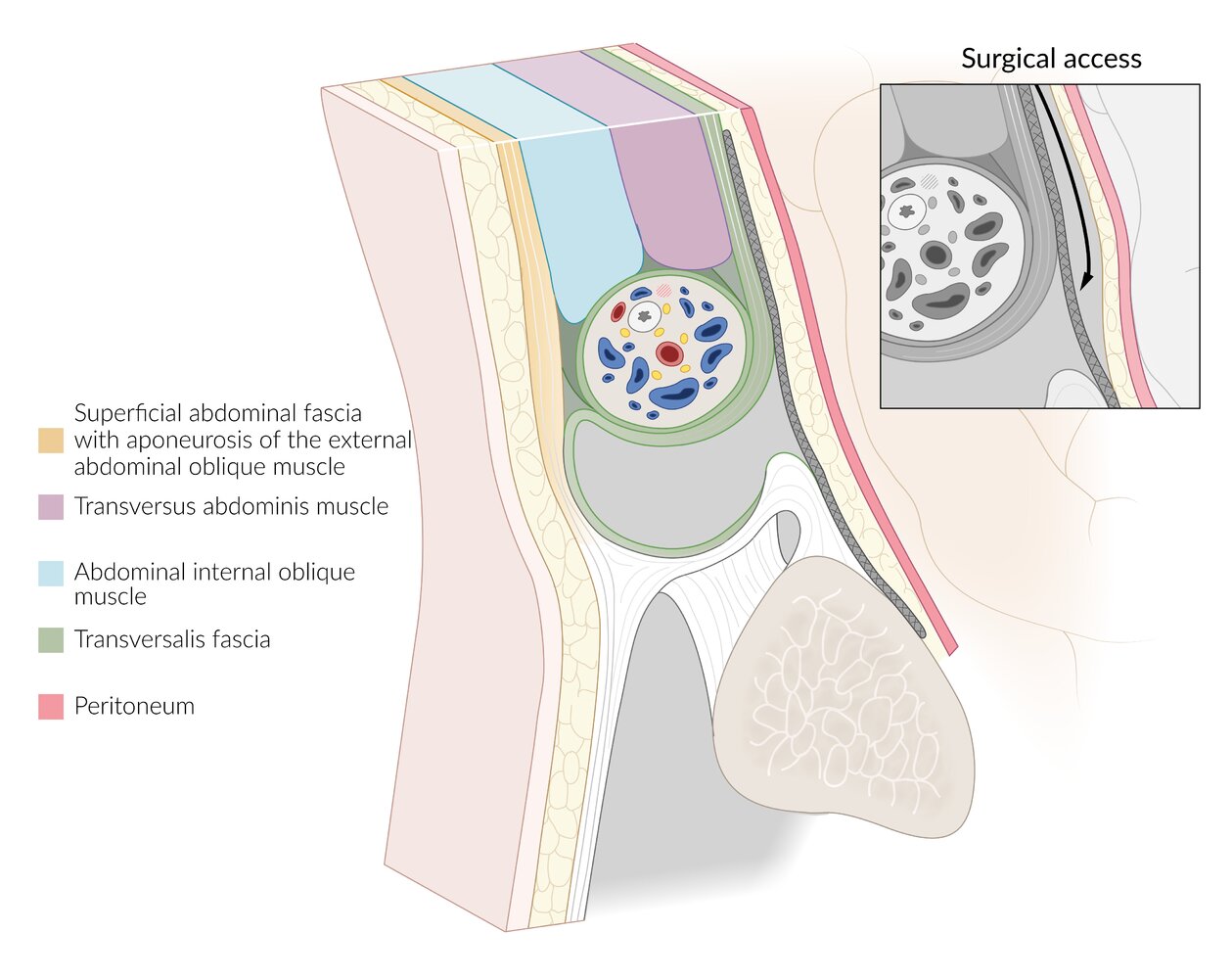 Total extraperitoneal repair (TEP)