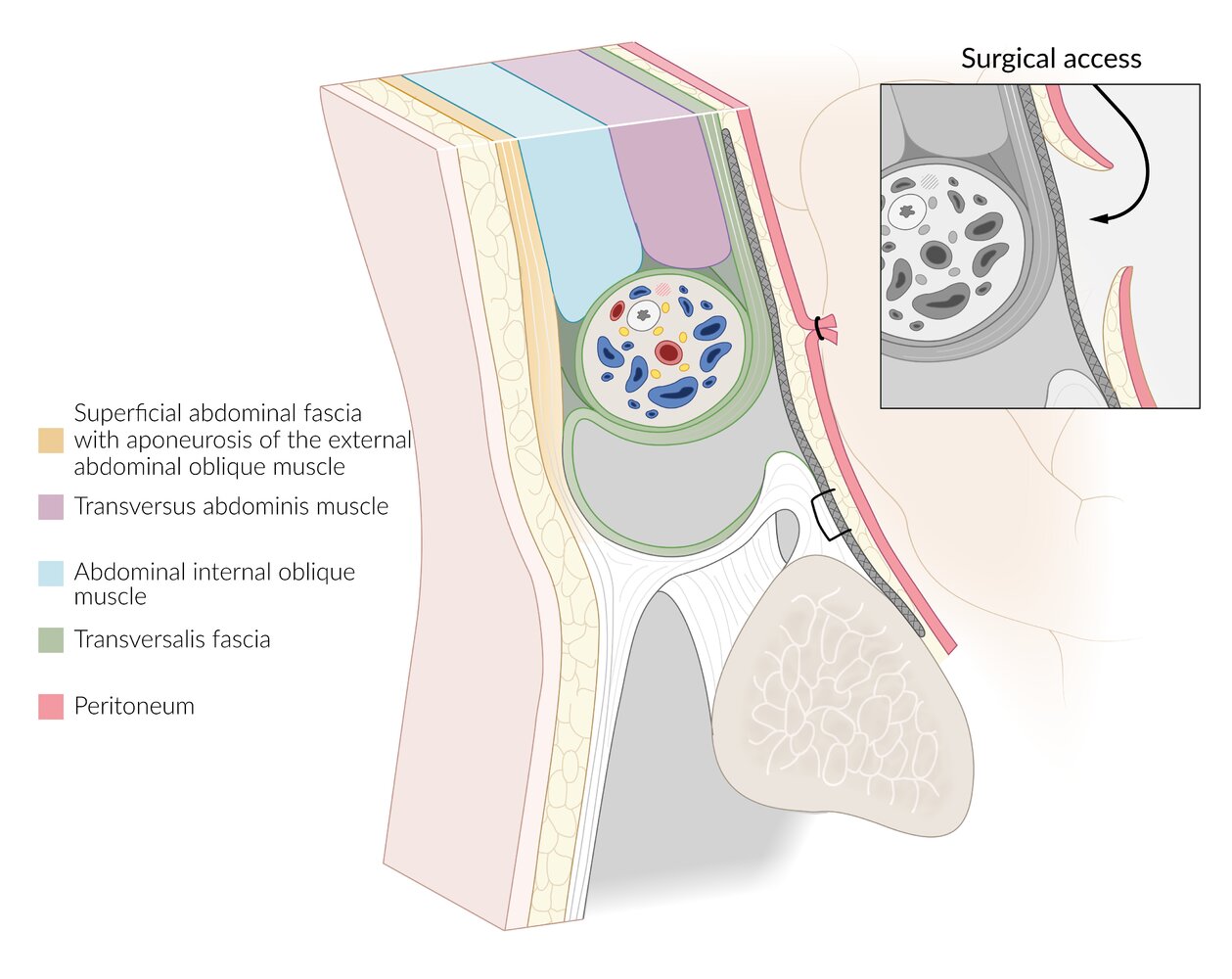 Transabdominal preperitoneal repair (TAPP)