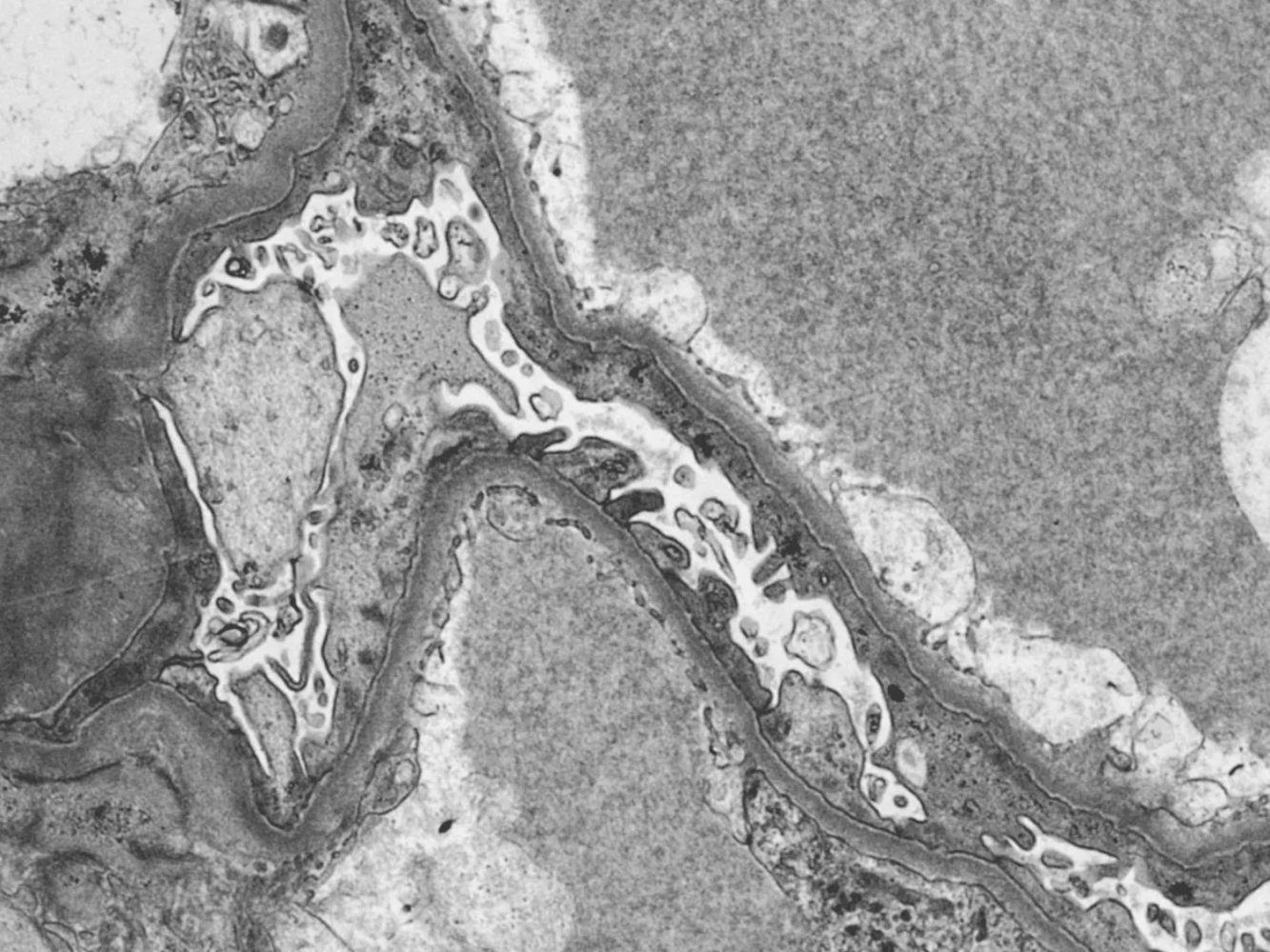 Podocyte foot processes fusion in minimal change disease