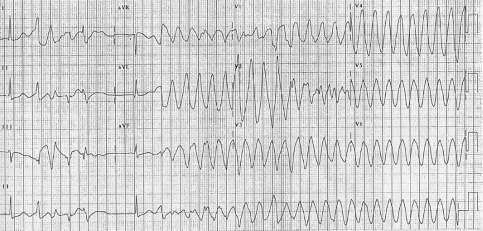 Torsades de pointes