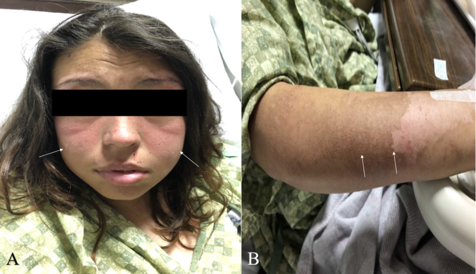 Systemic lupus erythematosus