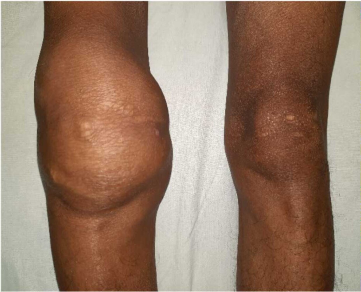 Tuberculous arthritis