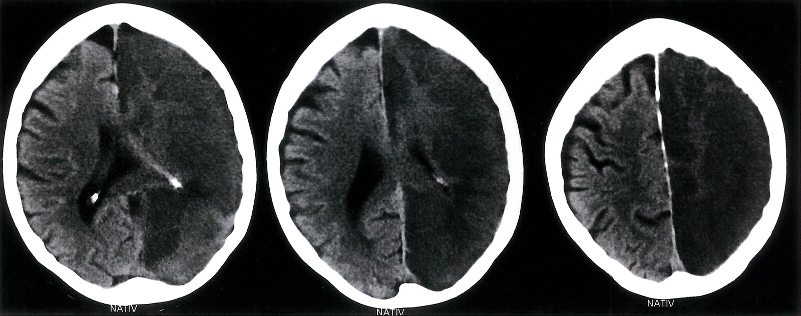 Large left hemispheric cerebral infarct