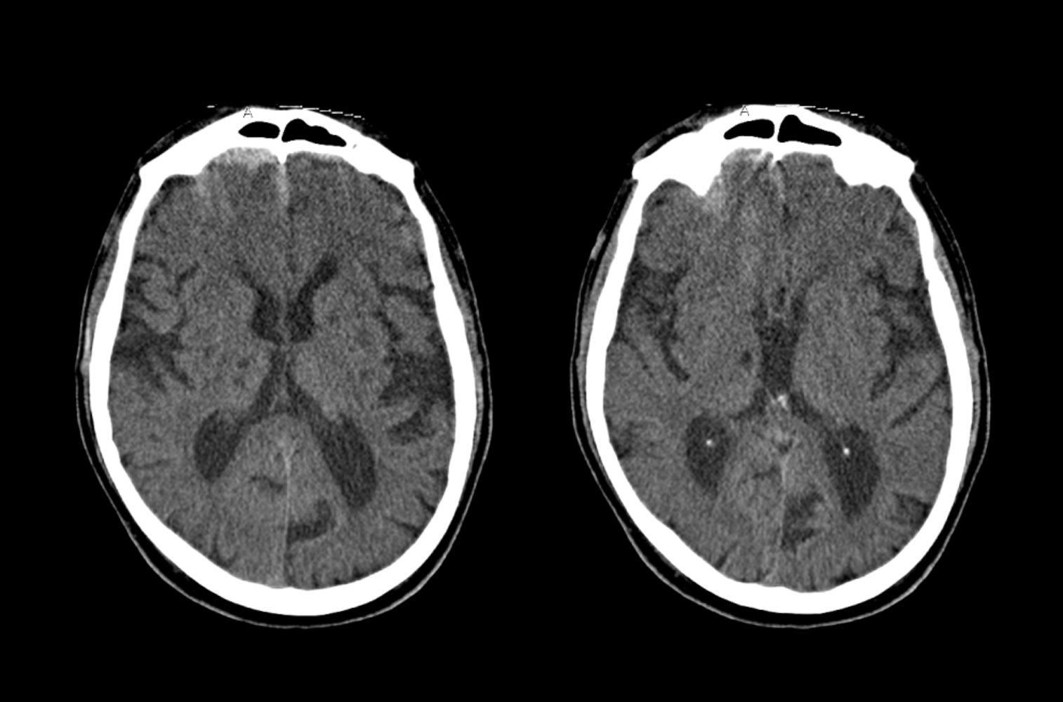 Chronic lacunar infarcts