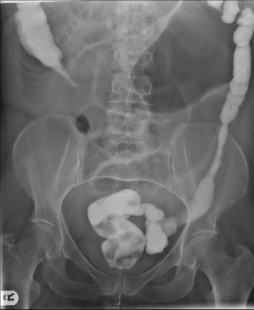 Bird beak sign in cecal volvulus