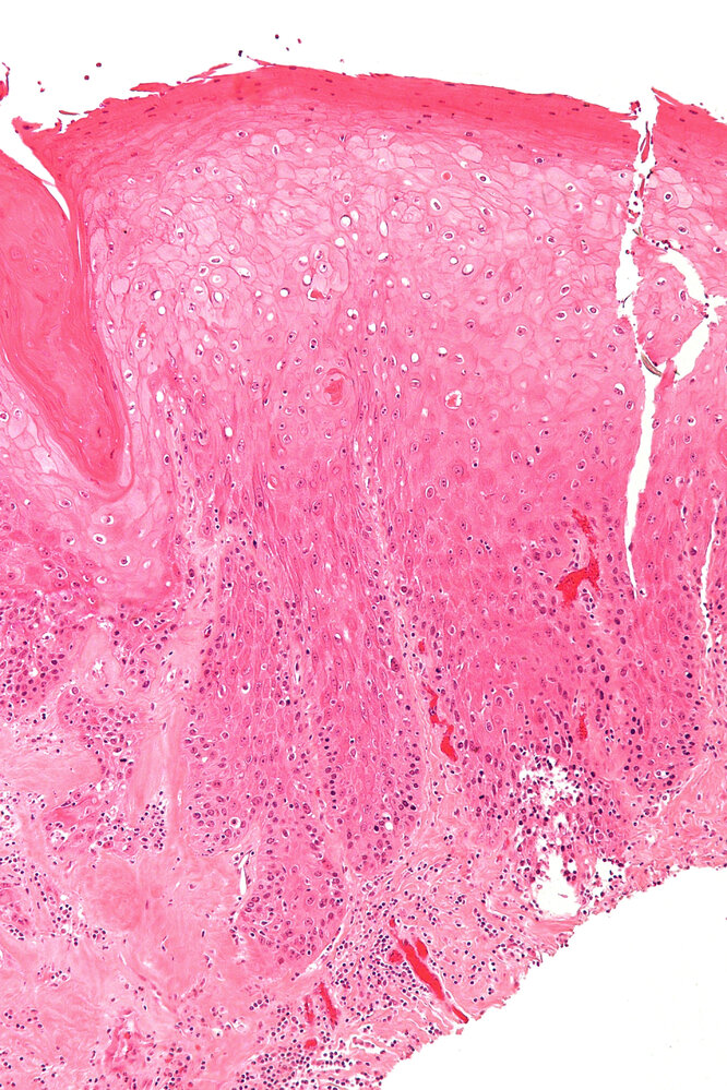 Differentiated vulvar intraepithelial neoplasia