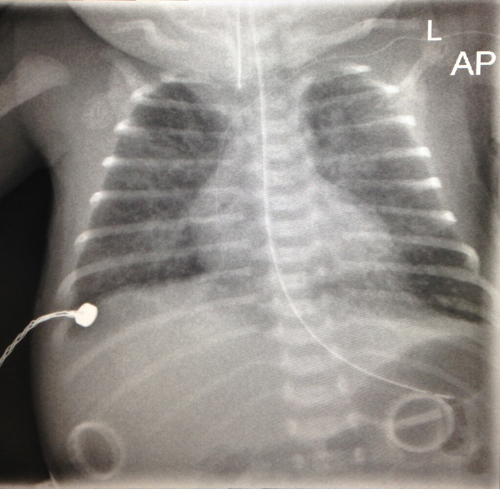 Respiratory distress syndrome (1/3)