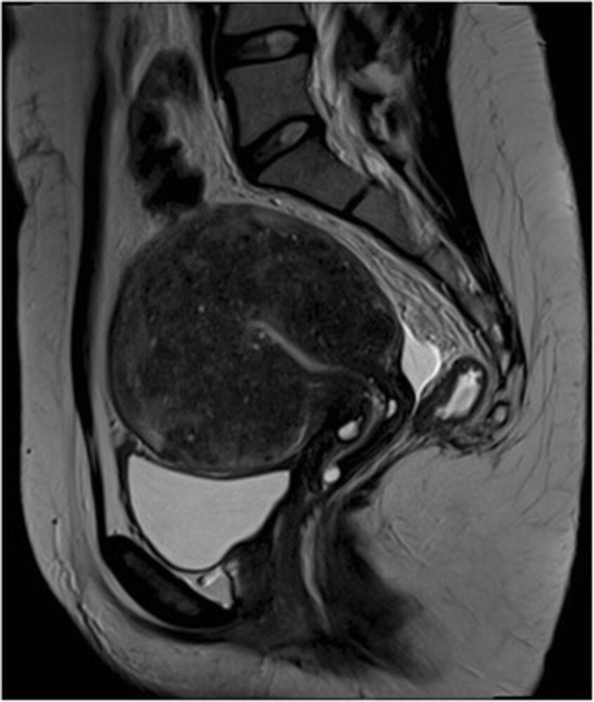 Uterine adenomyosis