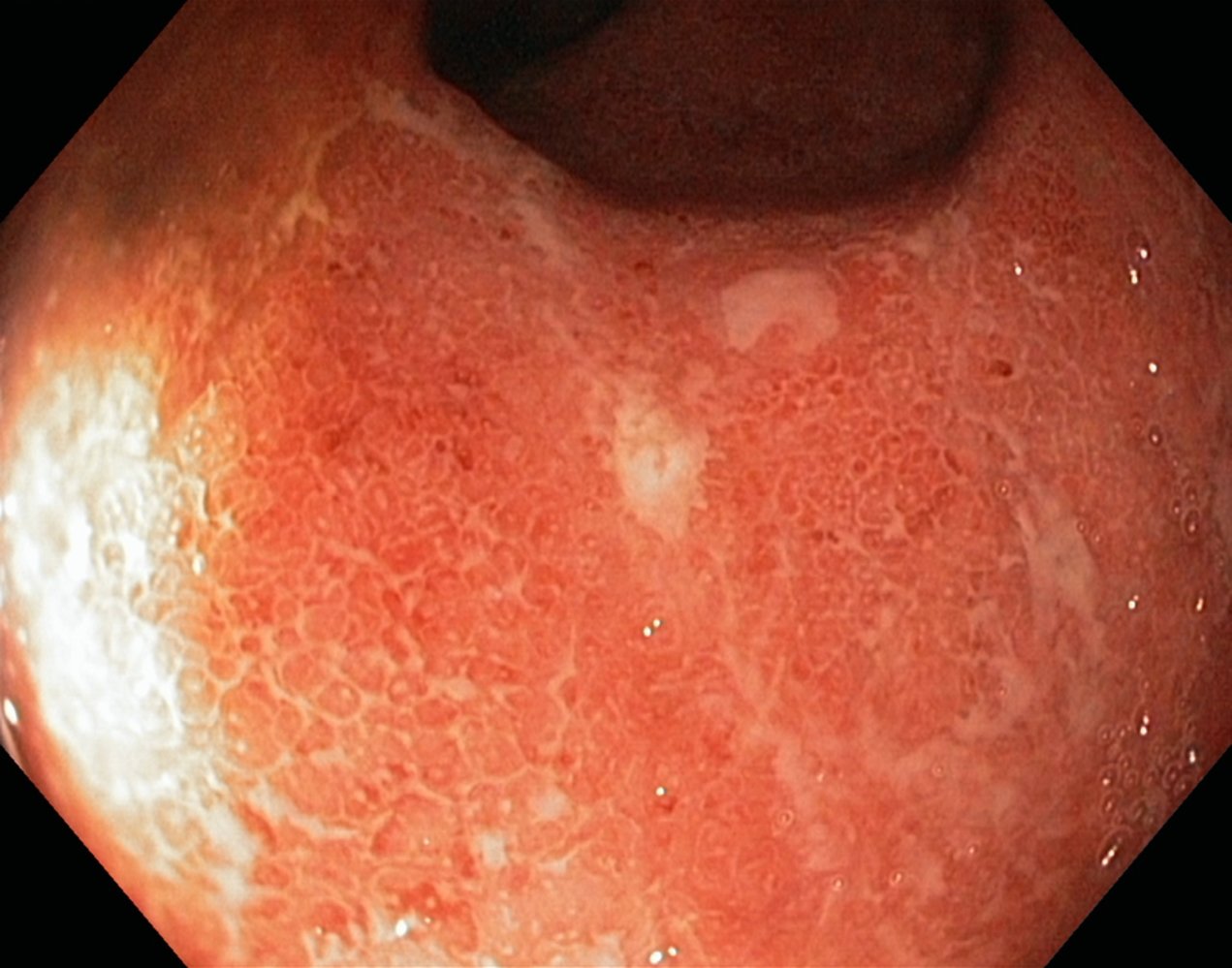 Acute ulcerative colitis