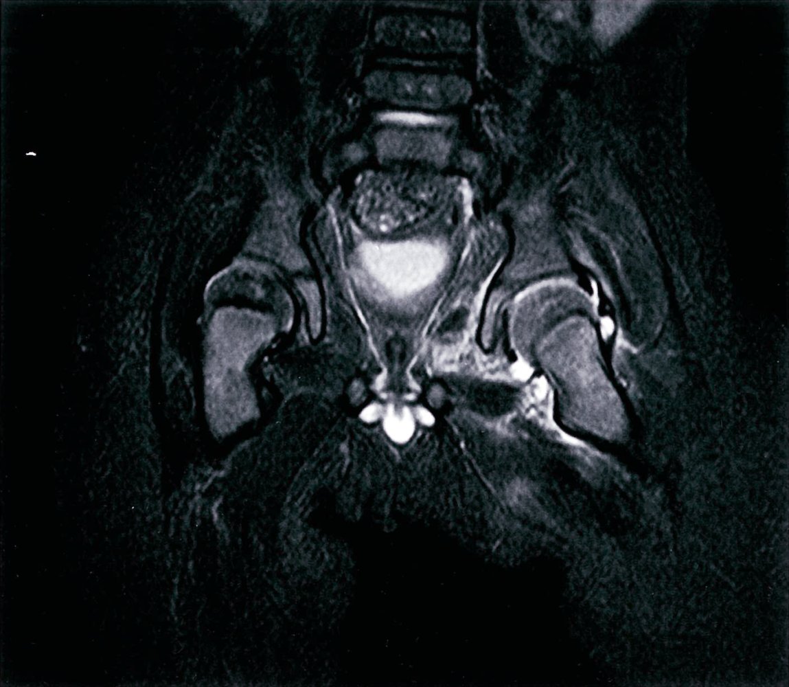 Left hip joint effusion