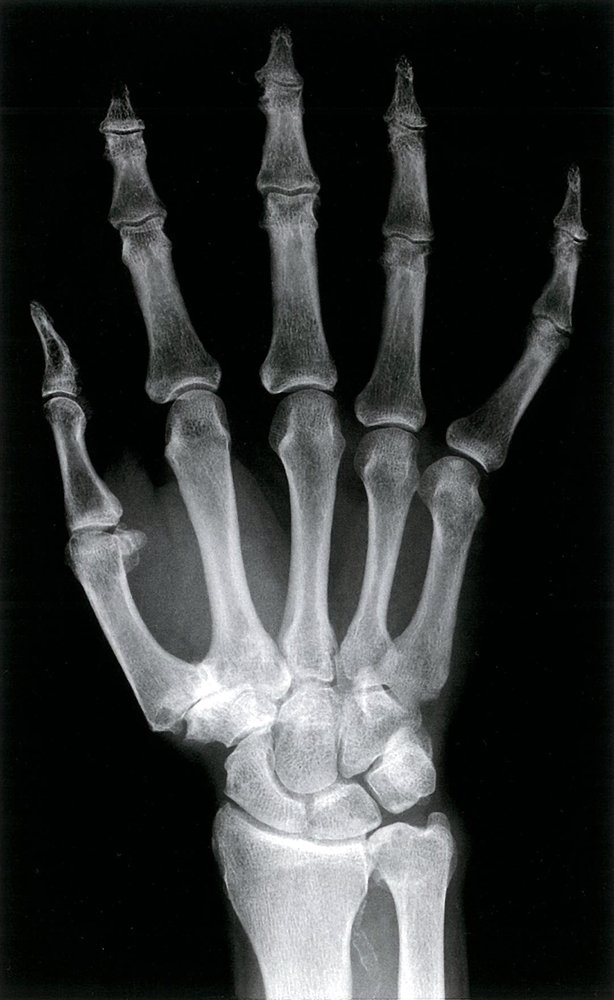 Carpometacarpal osteoarthritis