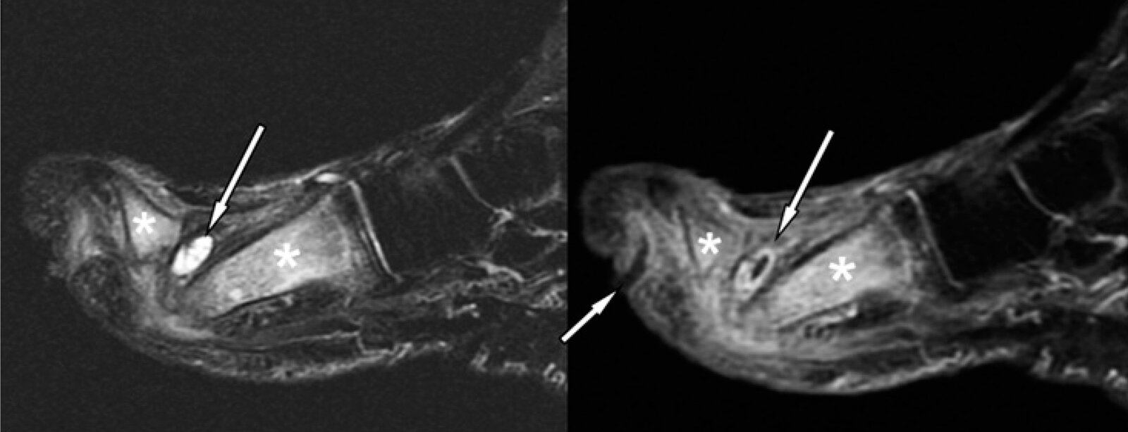 Foot ulcer with abscess and osteomyelitis