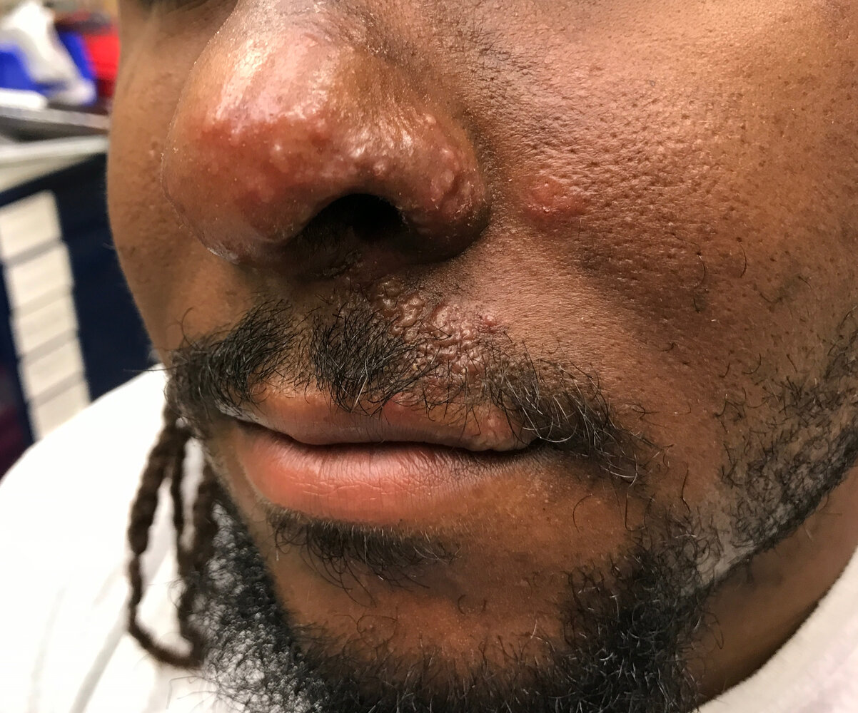 Hutchinson sign of the nose