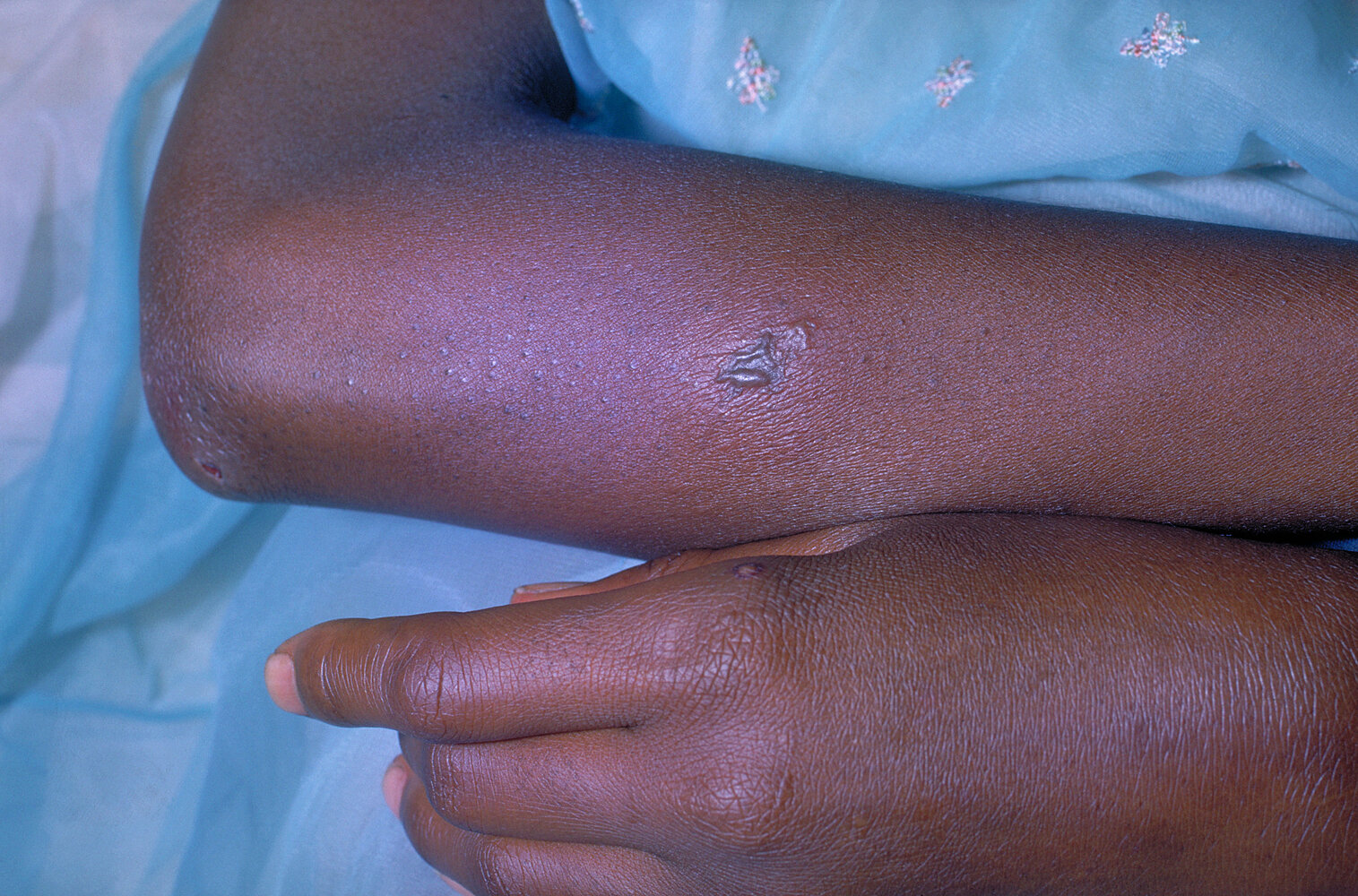 Skin lesion in disseminated gonococcal infection