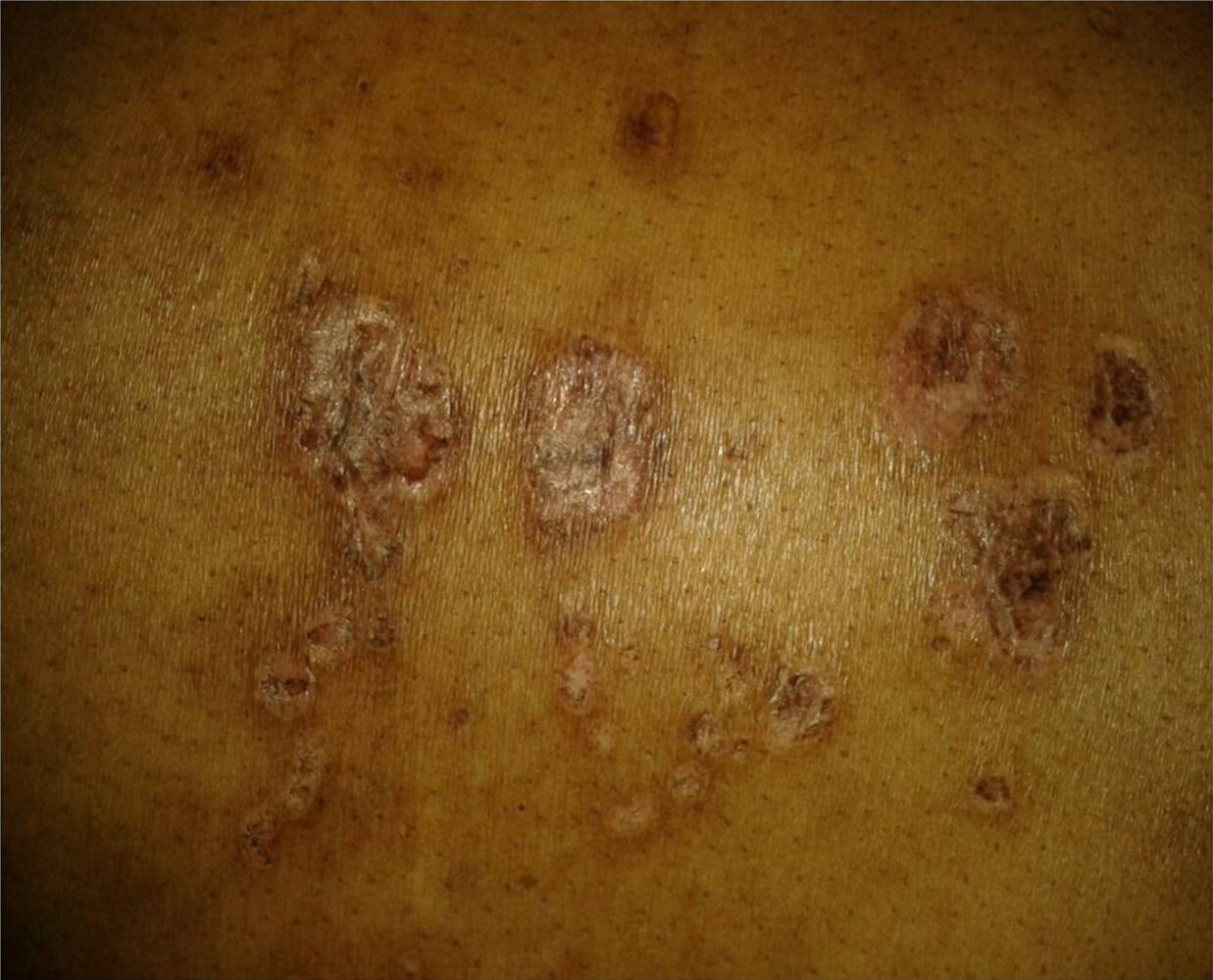 Discoid systemic lupus erythematosus