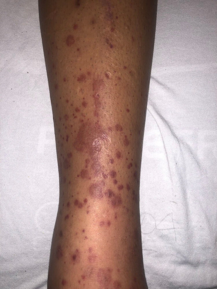 Purpura in IgA vasculitis