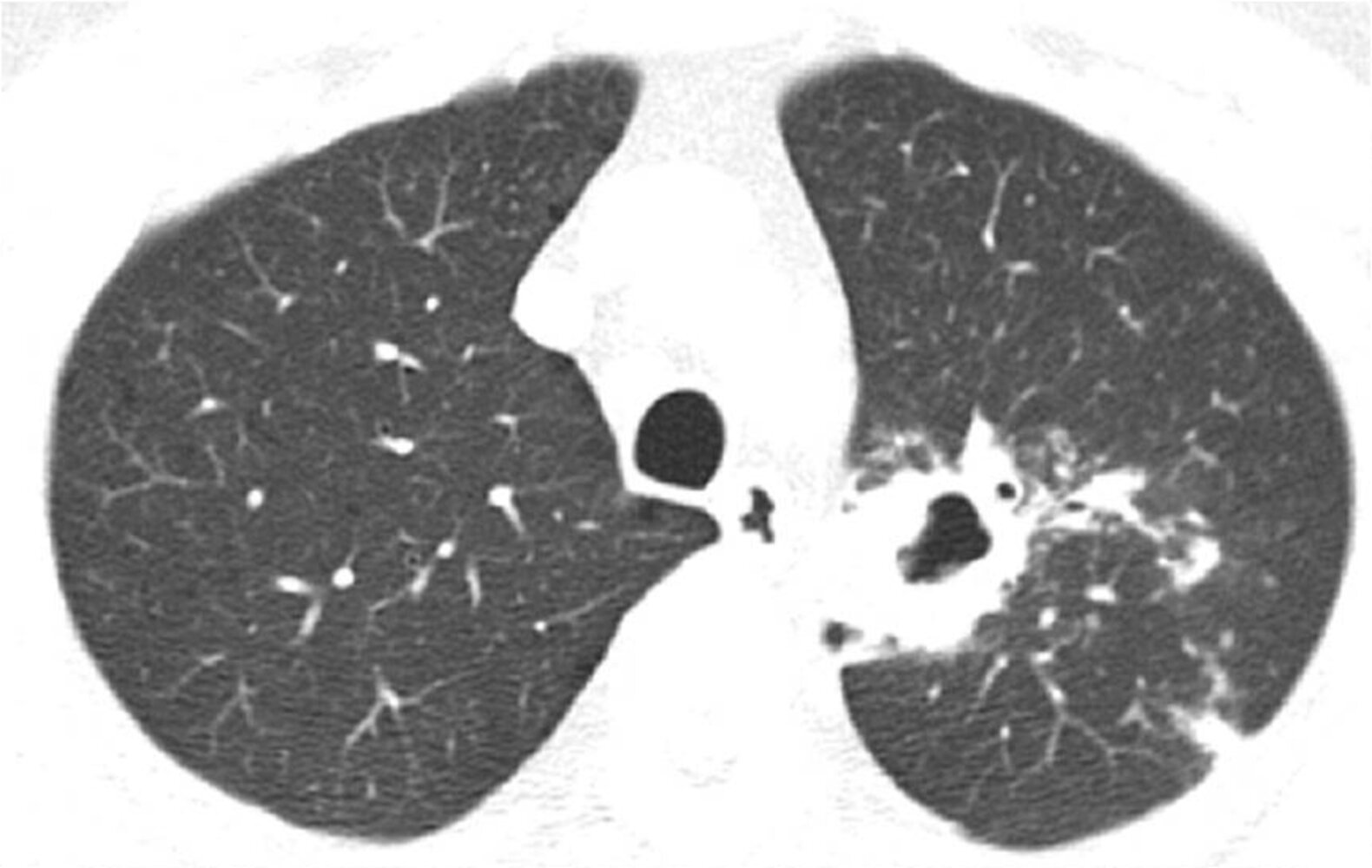 Cavitary lung lesion