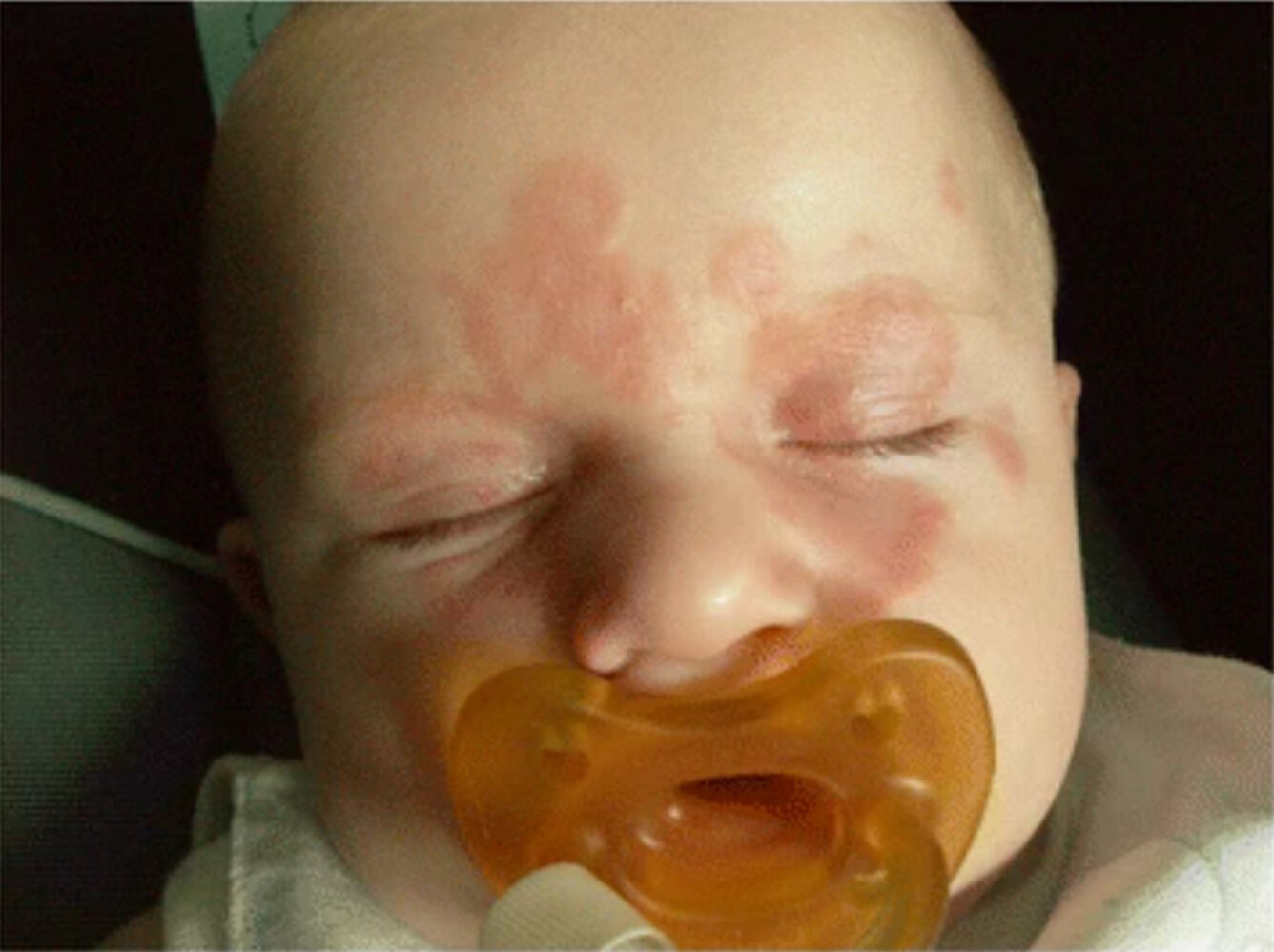 Neonatal lupus syndrome