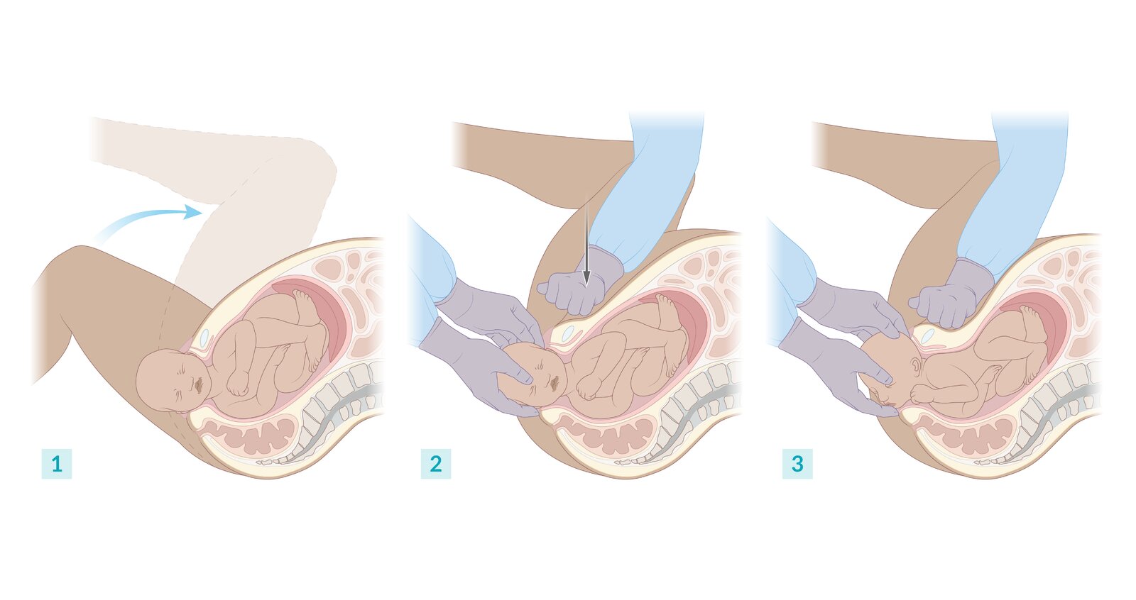 McRoberts maneuver and suprapubic pressure (Rubin I maneuver) in shoulder dystocia
