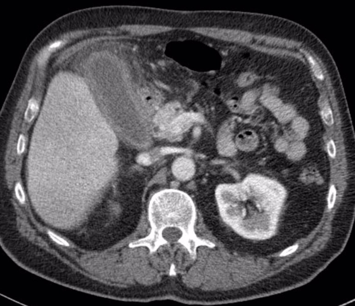 Acute acalculous cholecystitis