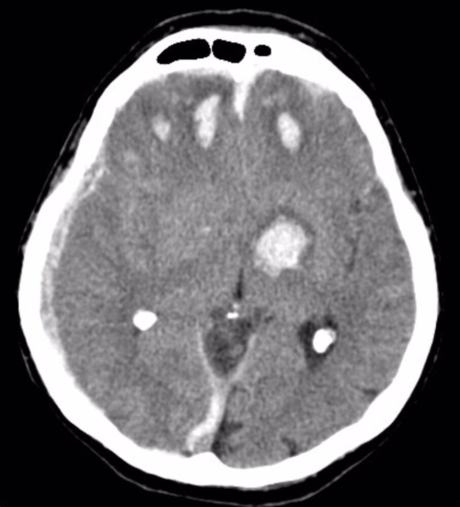 Post traumatic intracerebral hemorrhage
