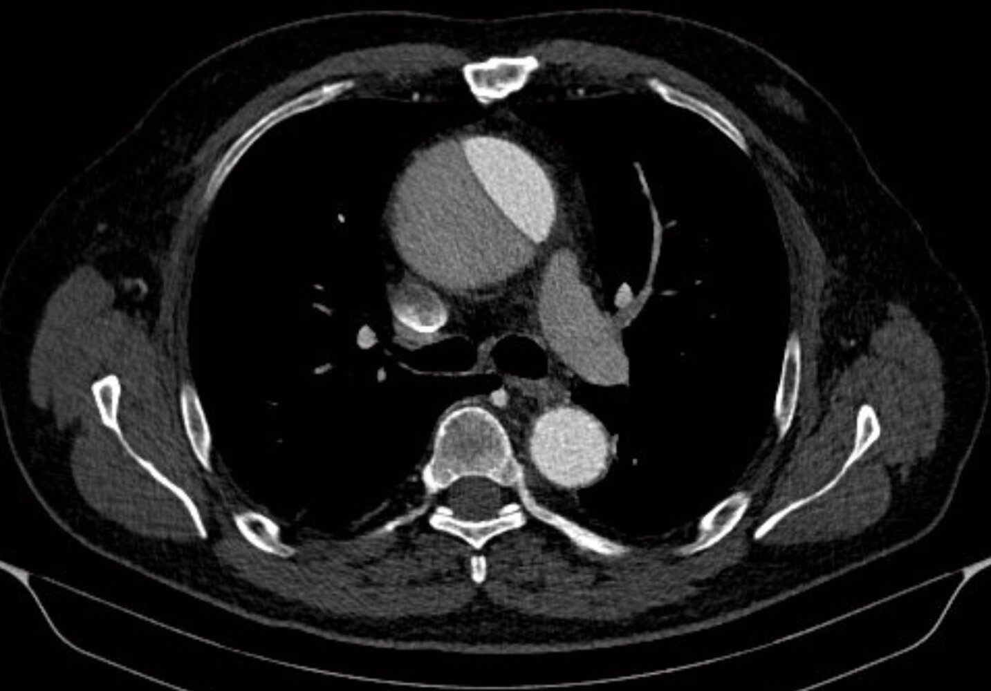 Aortic dissection (Stanford A)