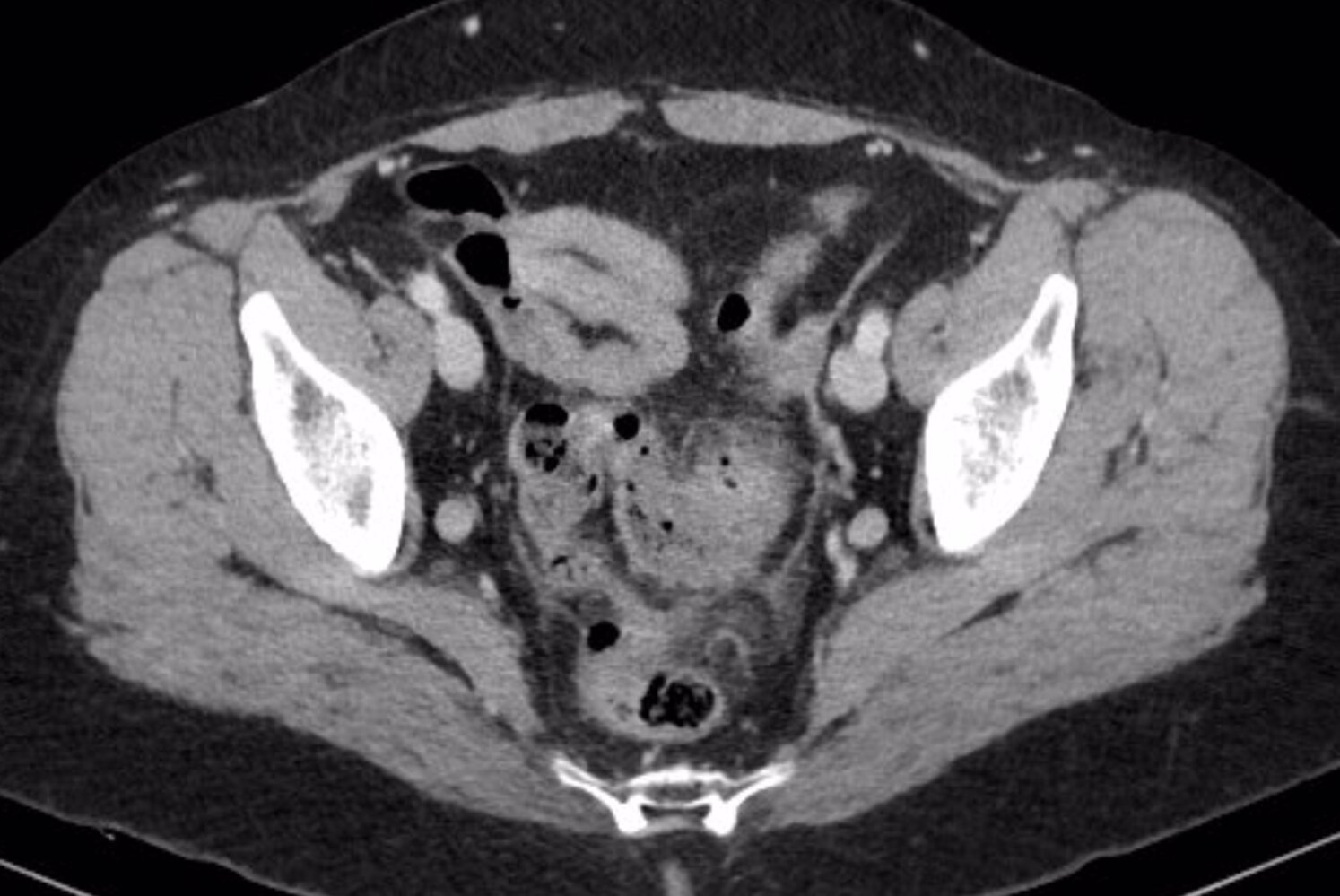 Sigmoid diverticulitis