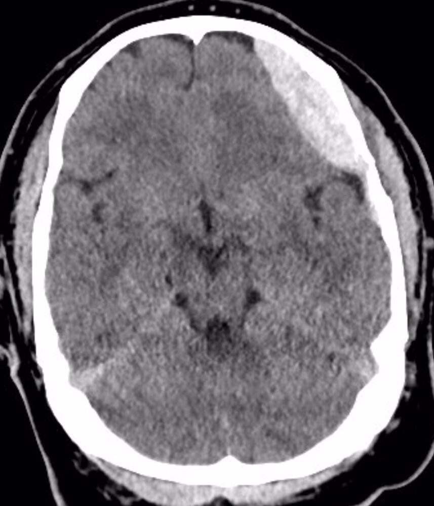 Epidural and subdural hematomas