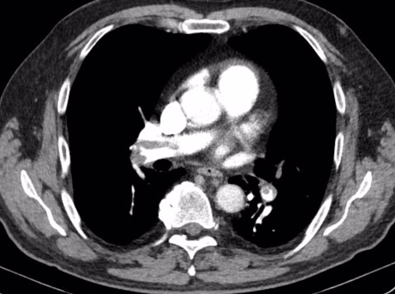 Acute and chronic pulmonary emboli