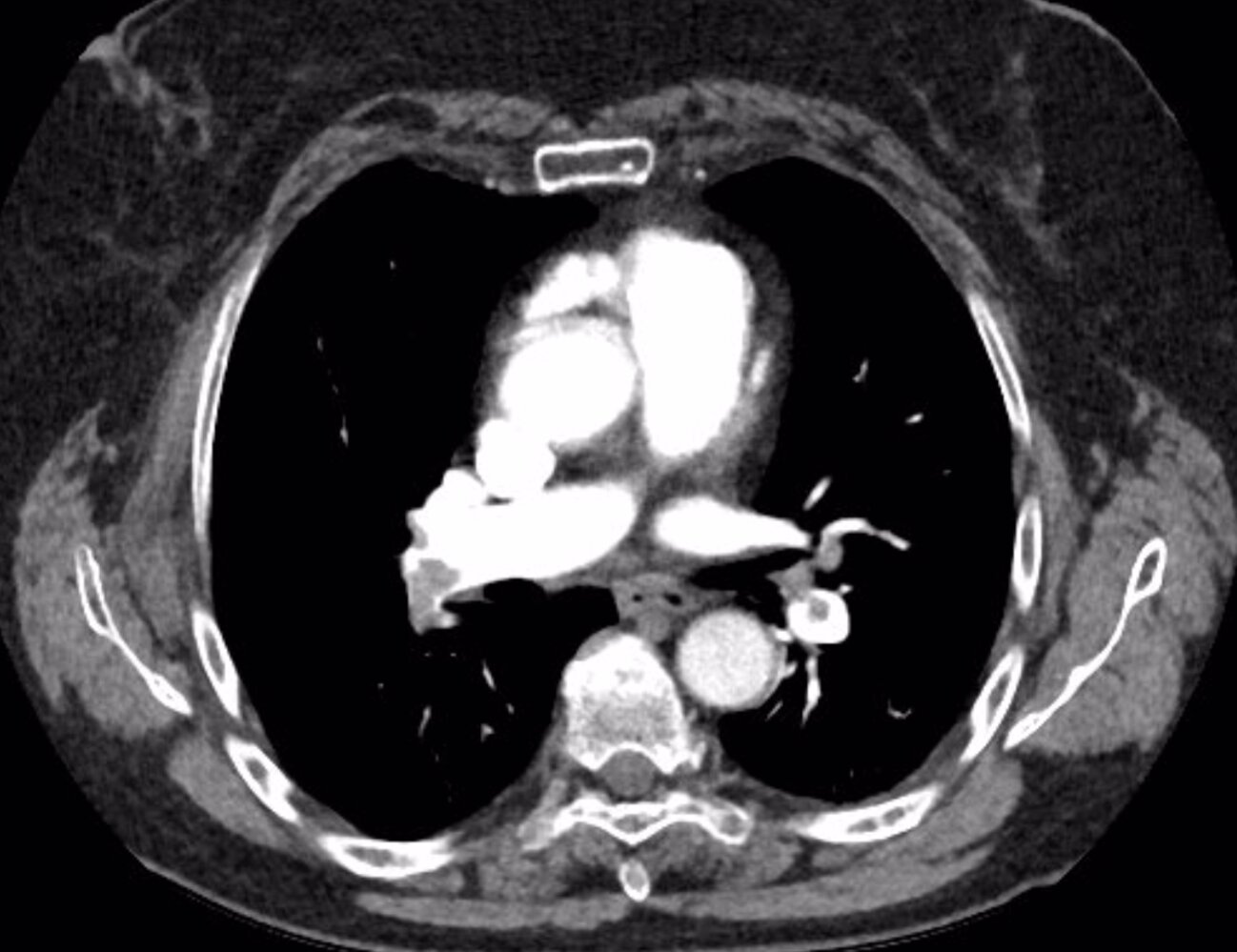 Pulmonary embolism