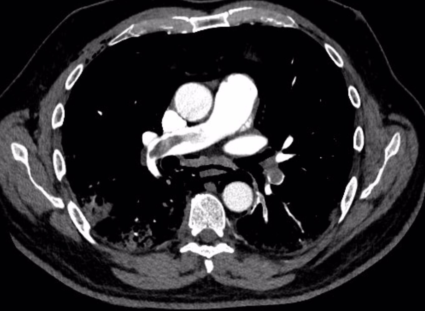 Pulmonary embolism and COVID-19-pneumonia