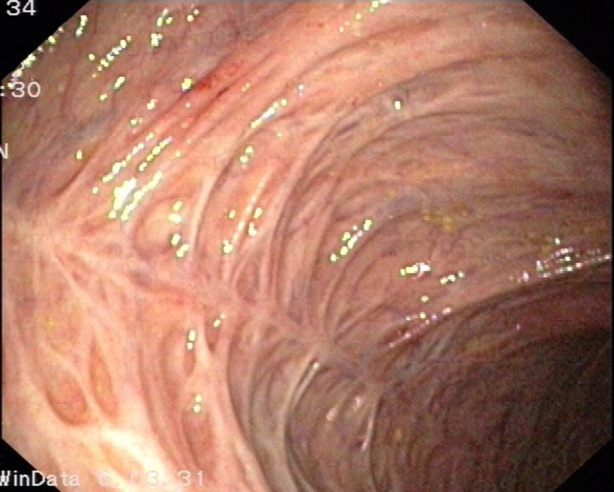 Ulcerative colitis in remission