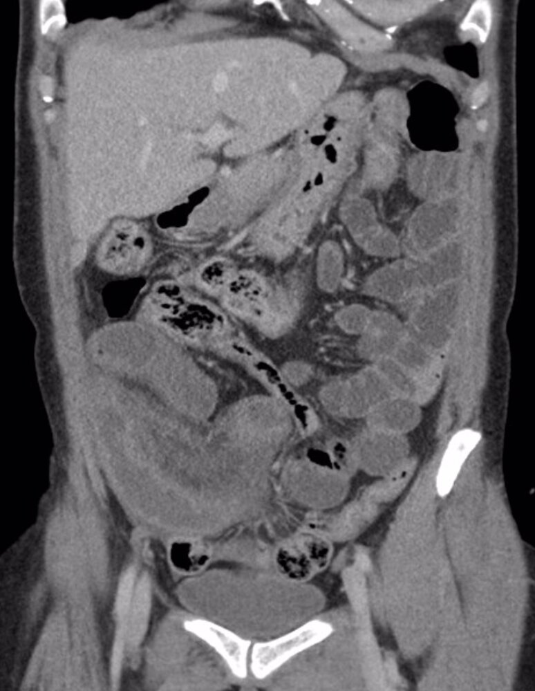 Small bowel obstruction