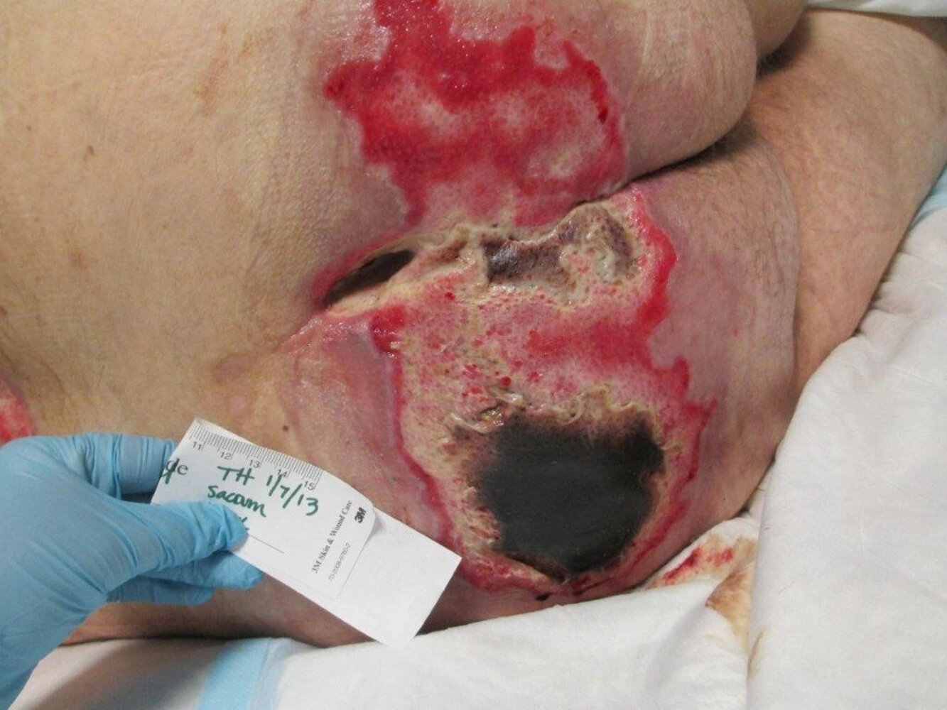 Unstageable decubitus ulcer
