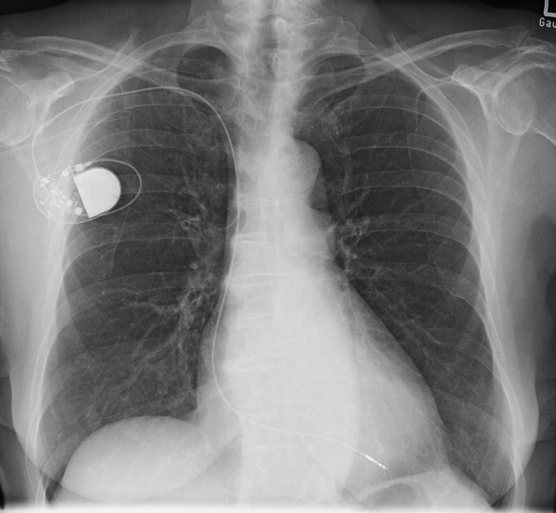 Single-chamber cardiac pacemaker