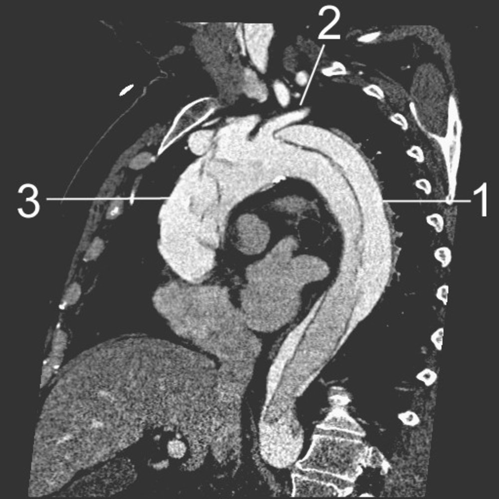Aortic dissection (Stanford A)
