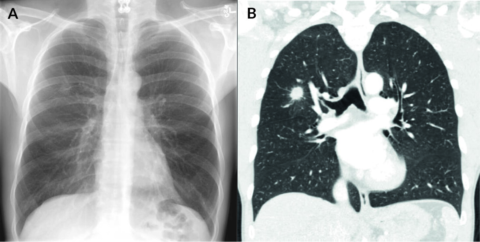 Spiculated lung mass