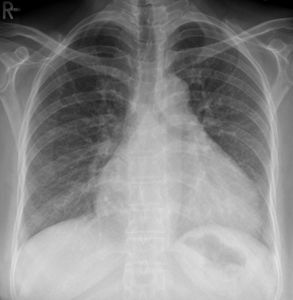 Enlarged cardiac silhouette