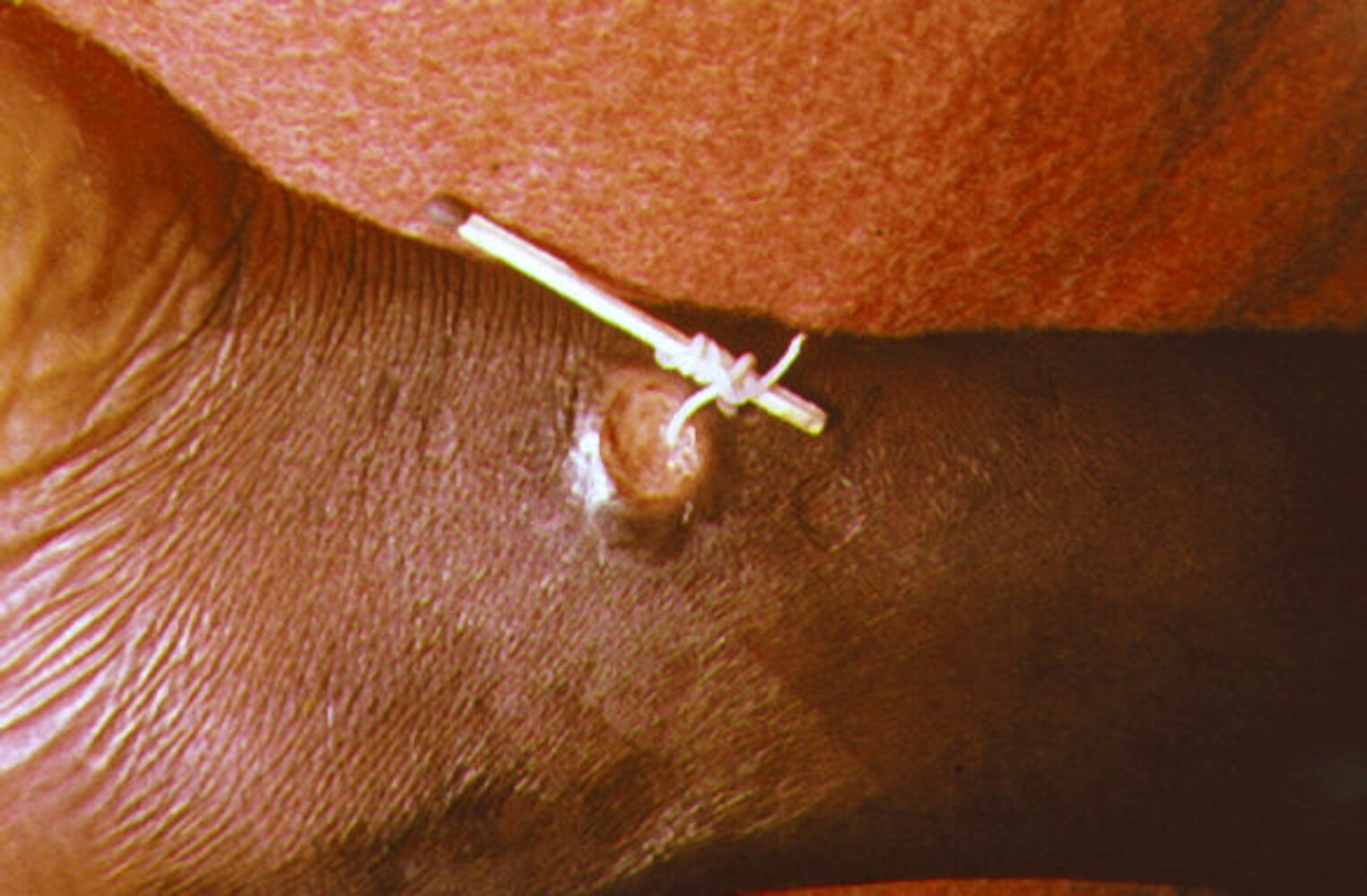 Guinea-worm removal