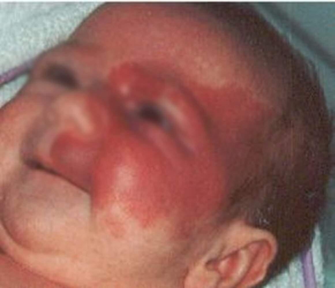Port-wine stain (nevus flammeus)