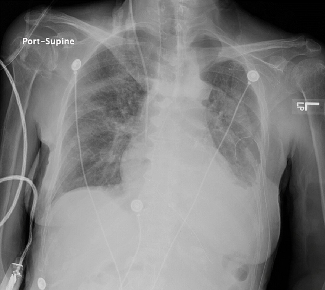 Correctly placed nasogastric tube