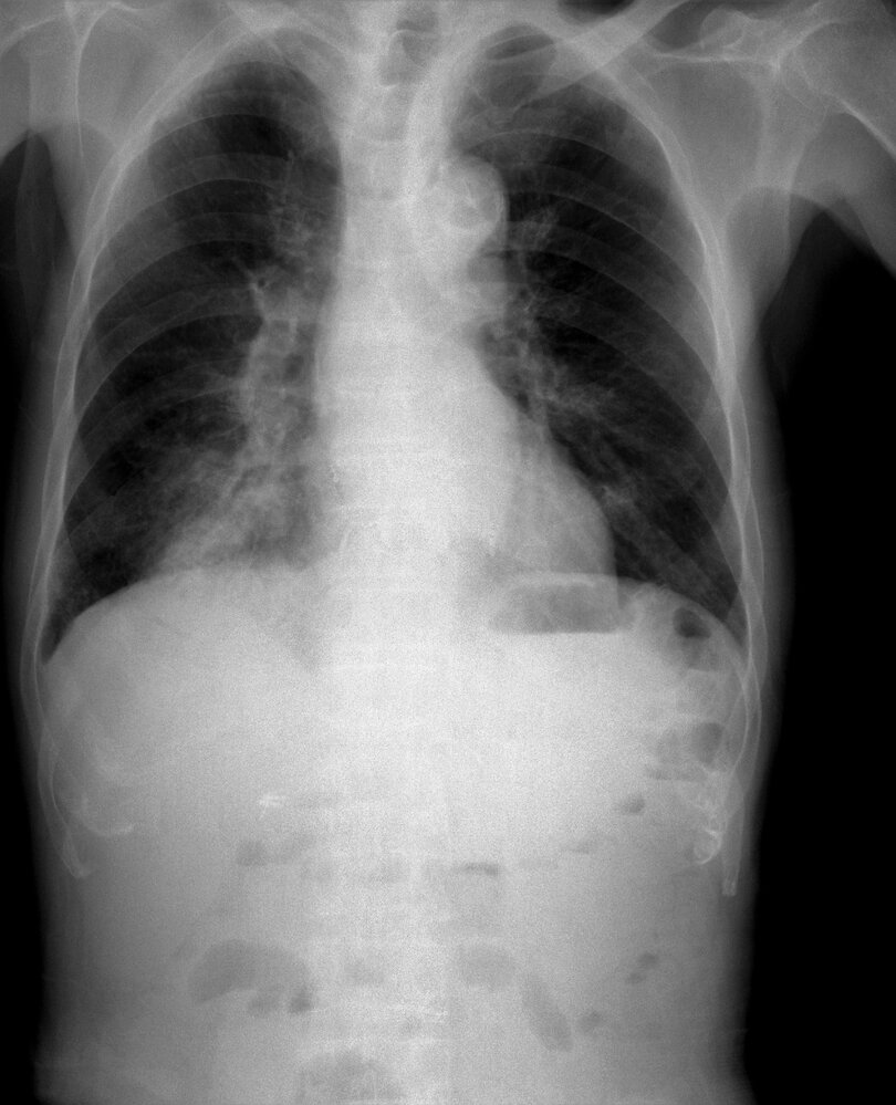 Right lower lobe consolidation
