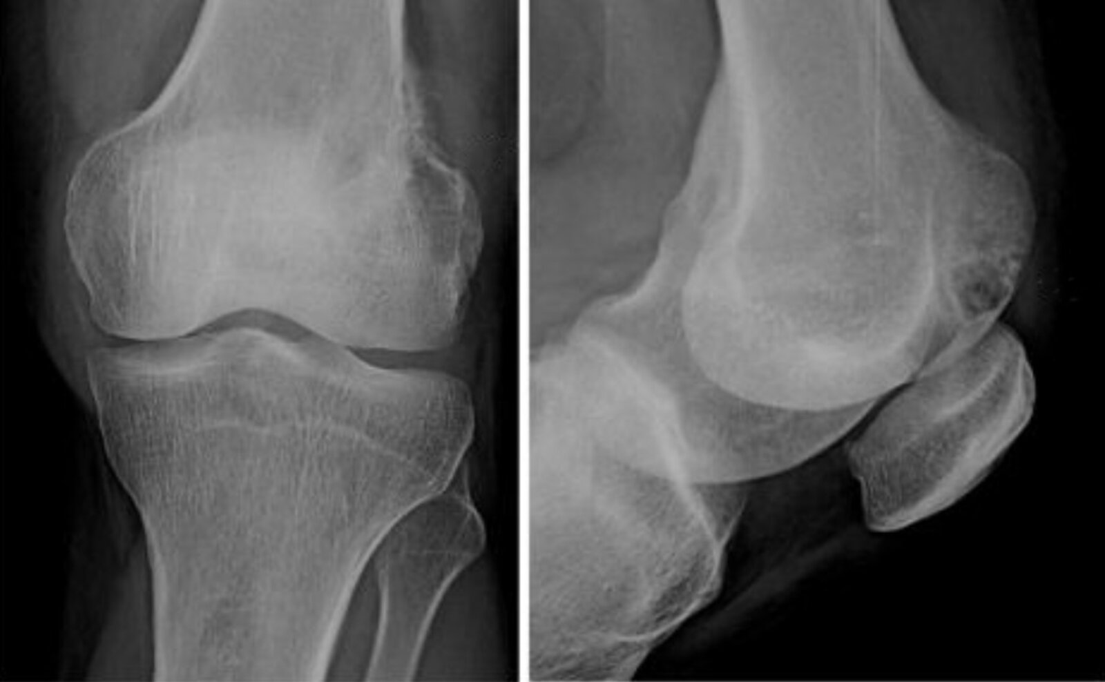 Gout of the knee