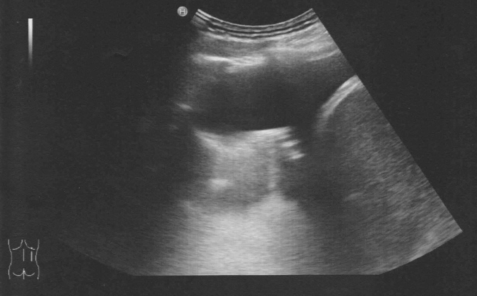 Pleural effusion