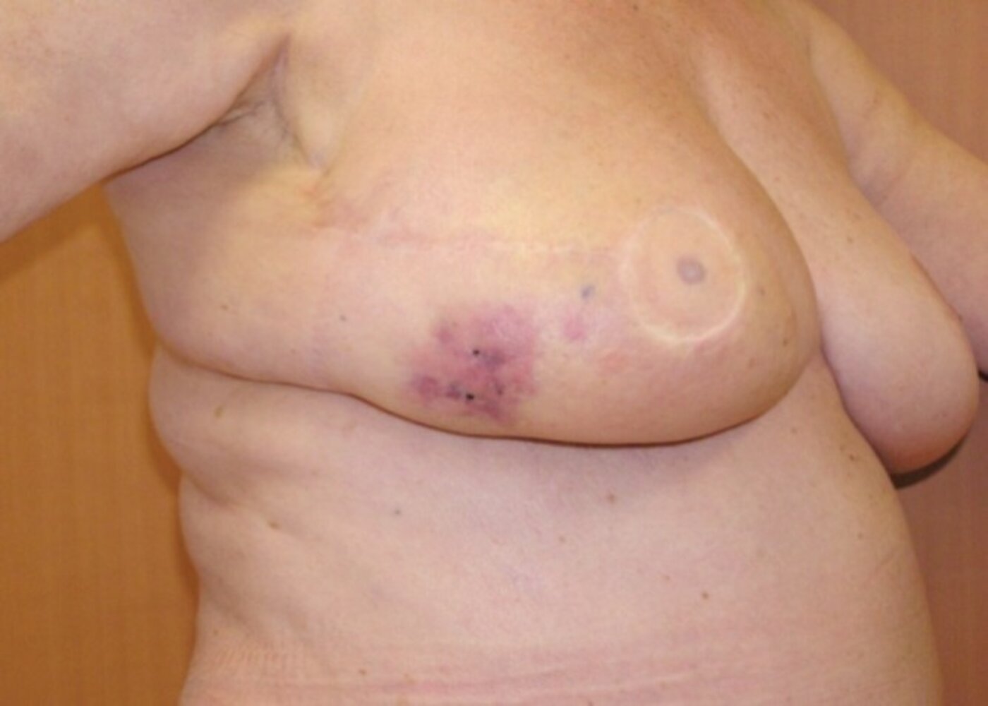Radiation-induced angiosarcoma of the breast