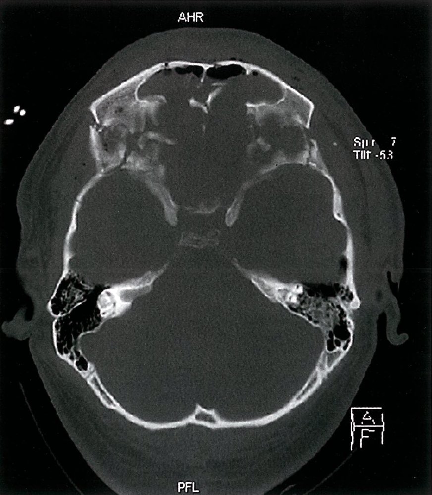 Anterior skull base fractures