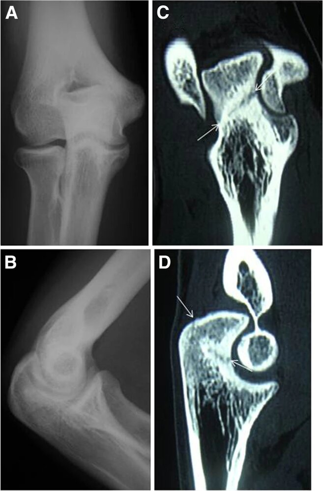 Olecranon stress fracture