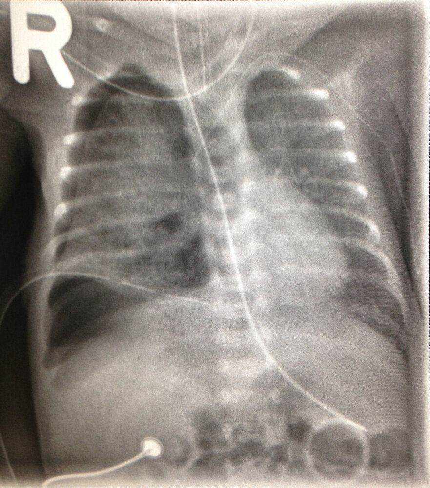Respiratory distress syndrome (2/3)